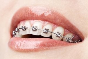 braces in schaumburg